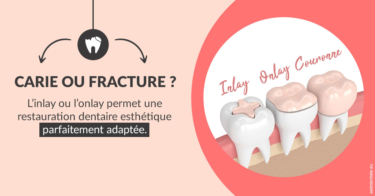 https://dr-rouhier-francois.chirurgiens-dentistes.fr/T2 2023 - Carie ou fracture 2
