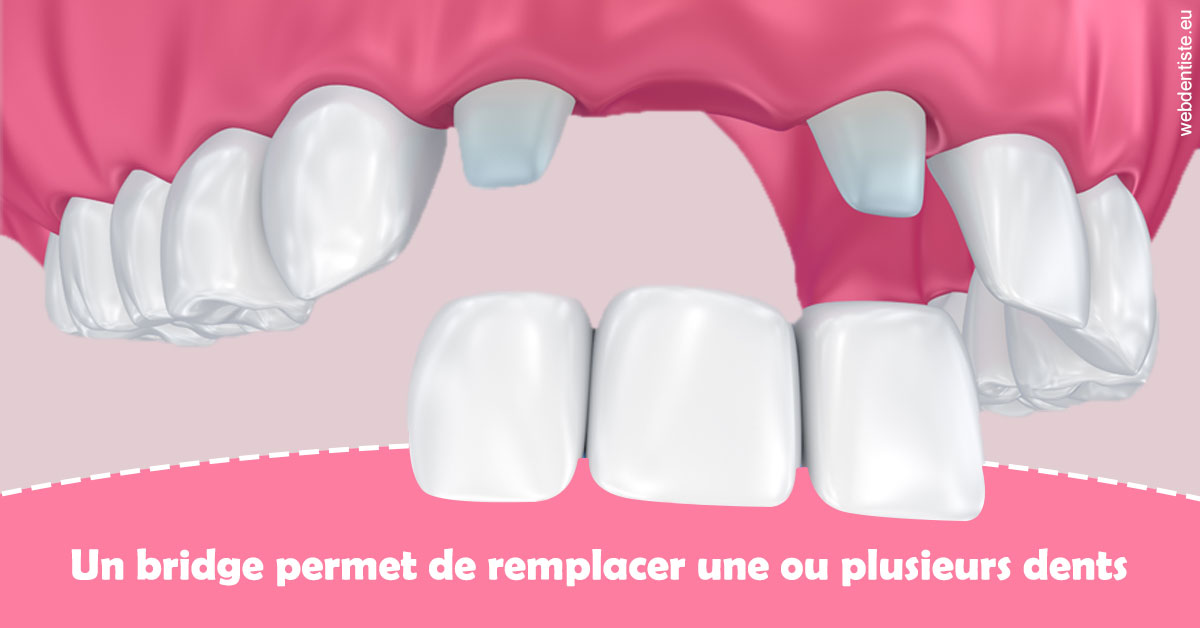 https://dr-rouhier-francois.chirurgiens-dentistes.fr/Bridge remplacer dents 2
