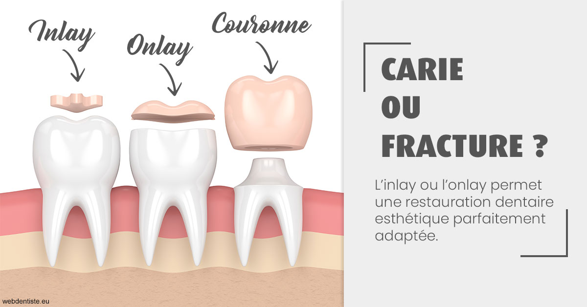 https://dr-rouhier-francois.chirurgiens-dentistes.fr/T2 2023 - Carie ou fracture 1
