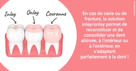 https://dr-rouhier-francois.chirurgiens-dentistes.fr/L'INLAY ou l'ONLAY 2